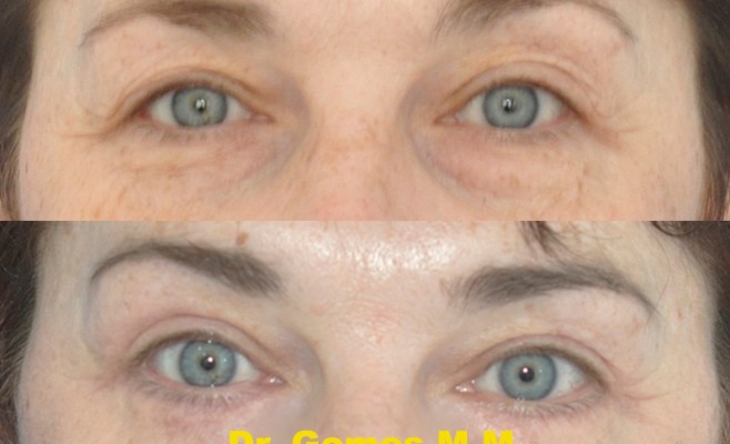 верх и ниж блефаро 3 мес п_о